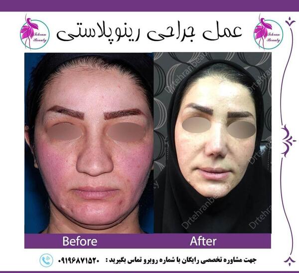 عکس سه بعدی قبل عمل بینی