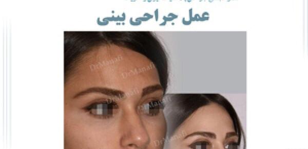عکس سه بعدی قبل عمل بینی