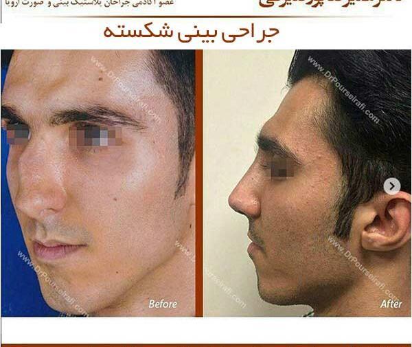 عکس سه بعدی قبل عمل بینی
