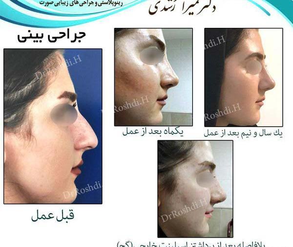 عکس سه بعدی قبل عمل بینی