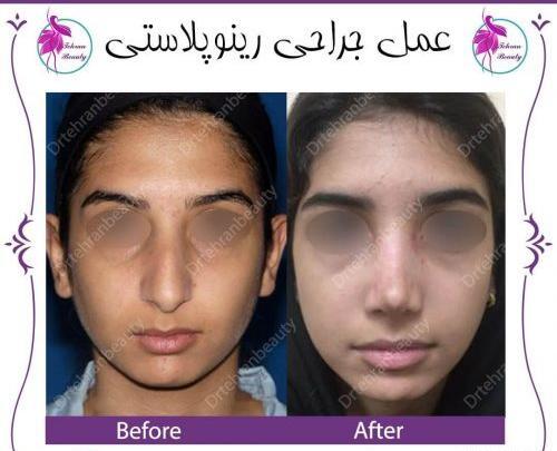 عکس سه بعدی قبل عمل بینی