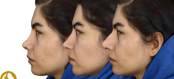 عکس سه بعدی قبل عمل بینی