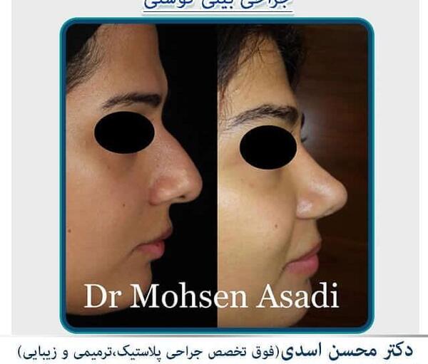 عکس سه بعدی قبل عمل بینی