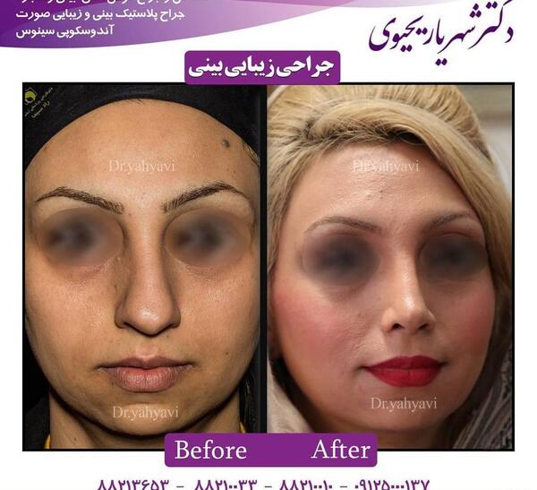 عکس سه بعدی قبل عمل بینی