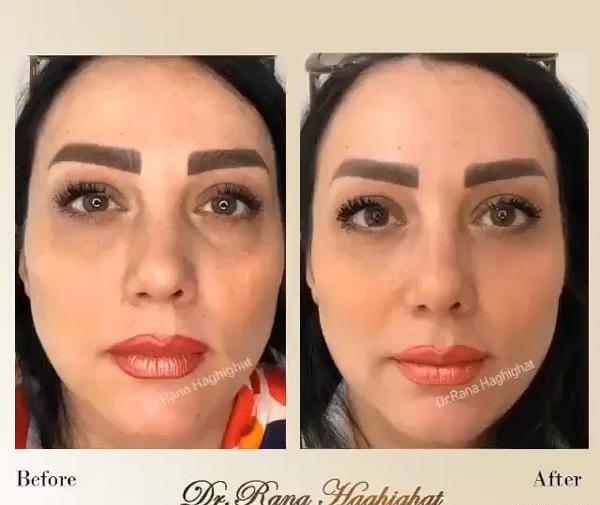 عکس ژل چشم