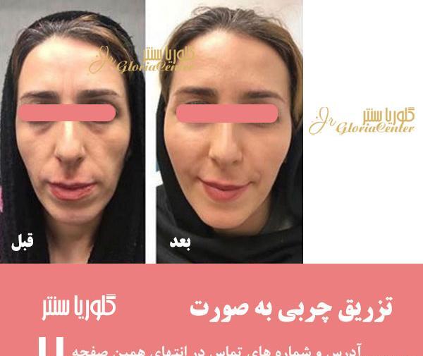 عکس ژل چشم