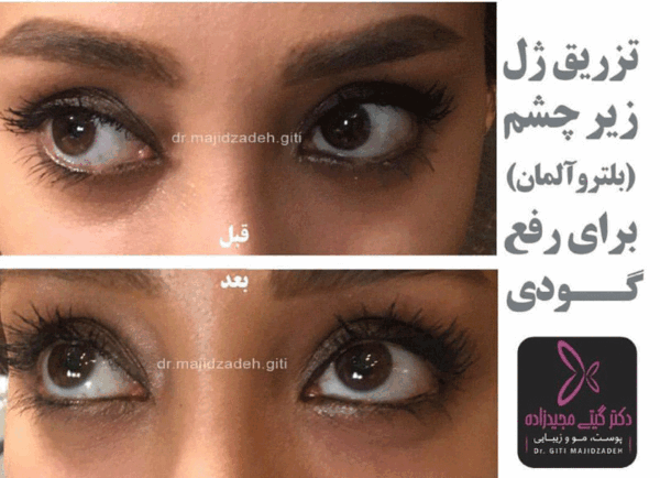 عکس ژل چشم