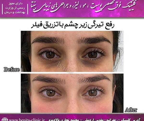 عکس ژل چشم