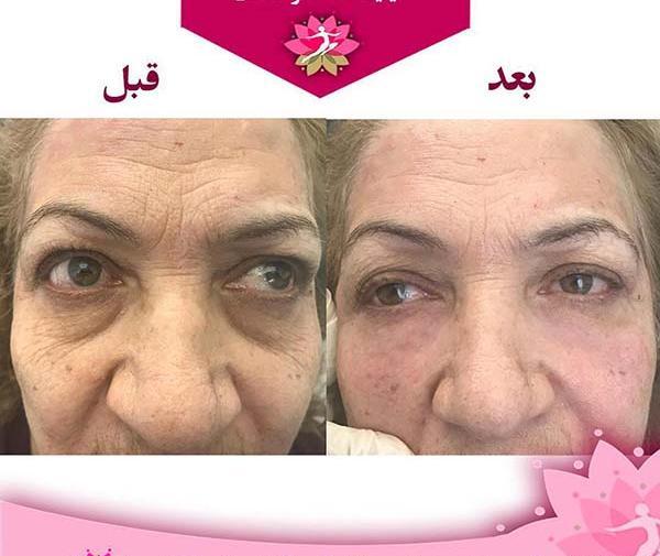 عکس ژل چشم