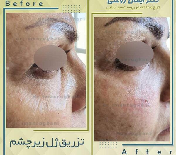 عکس ژل چشم