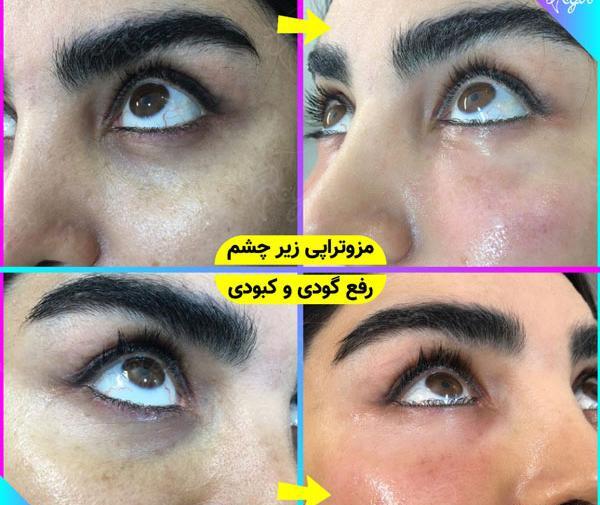 عکس ژل چشم