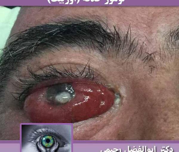 عکس چشم تخلیه شده
