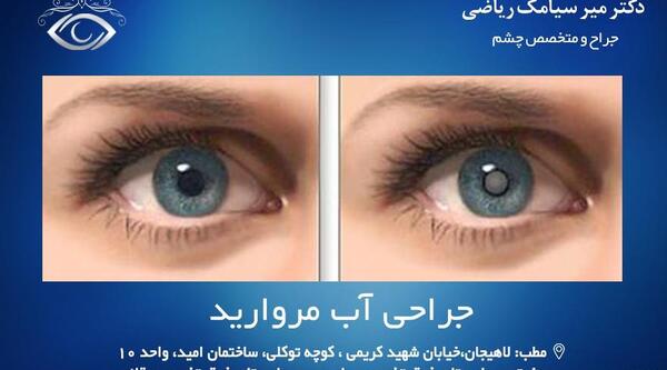 عکس چشم تخلیه شده