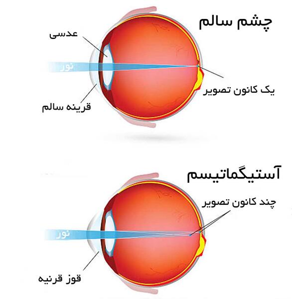 عکس ضعیفی چشم