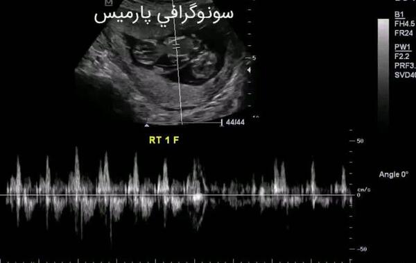 عکس سونوگرافی ضربان قلب پسر