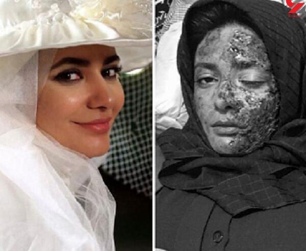 عکس بچه صورت سوخته