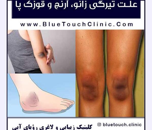 عکس سیاهی آرنج